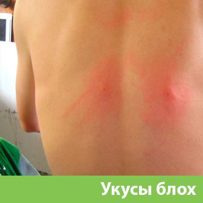 Укусы блох в Воронеже