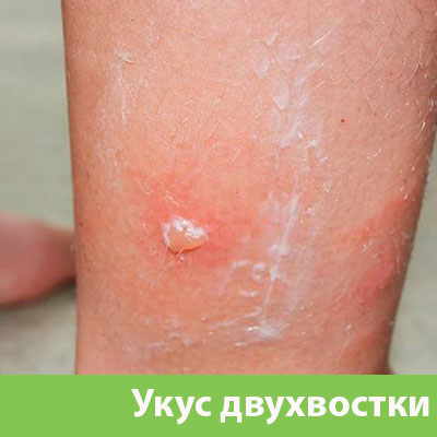Укус двухвостки в Воронеже