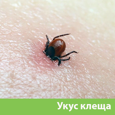 Укус клеща в Воронеже
