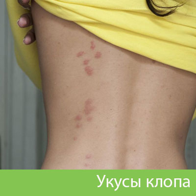 Профессиональное уничтожение клопов в Воронеже